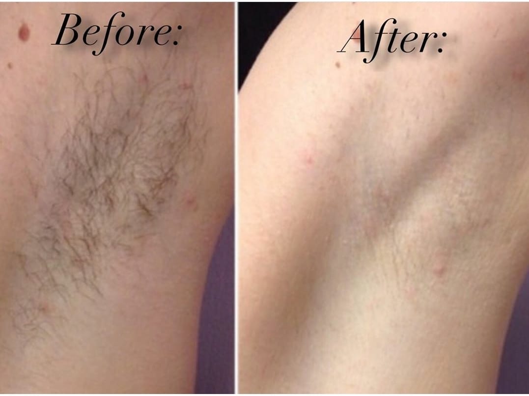 Bikini Laser Hair Removal