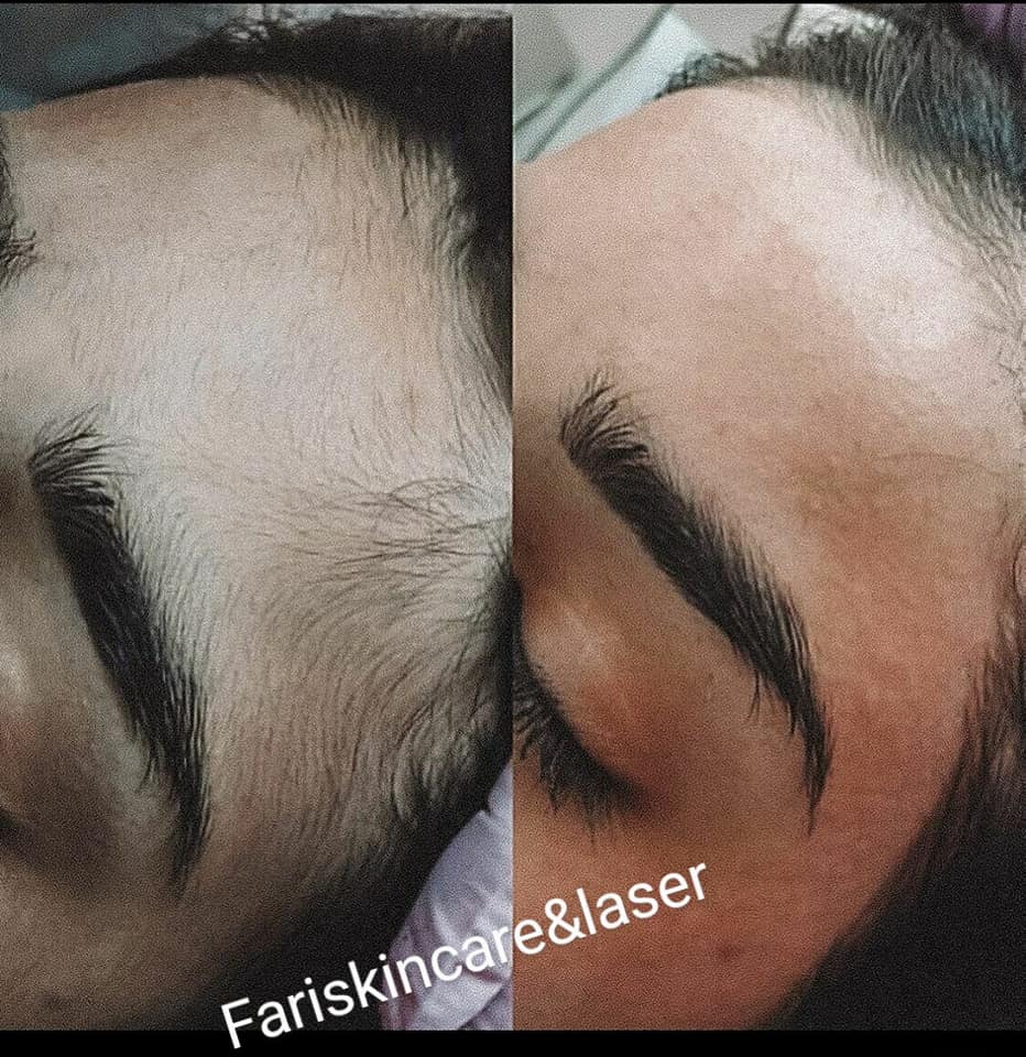 Laser Hair Removal in Karachi