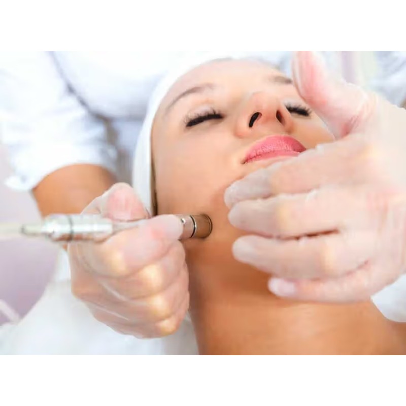 Microdermabrasion Facial Microdermabrasion Facial
